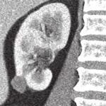 V literatuře se udává, že mírně stoupající tendence výskytu je následkem častějších incidentálních nálezů při vyšetřeních ultrasonografií a výpočetní tomografií (1, 2).