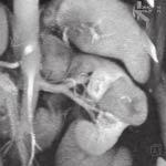 The kidney is supplied by single, early branching artery and by two veins (one of them being localized in the retroaortal space and forming circumaortal venous ring with the other one), metastatic