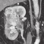 hematoxylin-eosin, zvětšení 400 x Fig. 4. Conventional renal cell carcinoma; T3a, N0, M0.