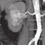 Tumor invades renal sinus, however, according to both histology and CT findings, infiltration of the renal pelvis or renal vein branches is not present. Translumbal nephrectomy was performed.