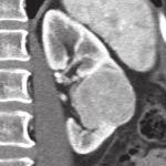 onkocytom rostoucí na pozadí objemného fibrózního stromatu, barvení hematoxylin-eosin, zvětšení 200 x Fig. 6. Differential diagnosis of the renal cell carcinoma renal oncocytoma.