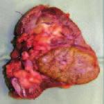 oncocytoma growing in the backround of the enlarged fibrous stroma, hematoxyllin-eosin staining, microphotograph, amgnification 200 x o mnohočetné tumory, jejichž velikost kolísá od několika
