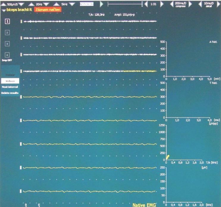 Obrázek 23 Mírně zvýšená svalová aktivita 6.1.2 Snímání EMG při volní kontrakci svalu Pacientovi necháme umístěné elektrody na stejné pozici. Jeho úkolem bude maximální volní kontrakce.