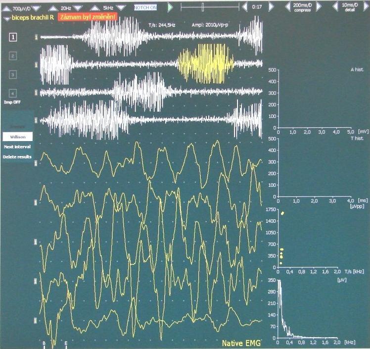 Obrázek 24 Maximální volní kontrakce pro m. biceps brachii 6.1.3 Izometrické zatížení obou končetin současně Pacient má opět umístěné snímací elektrody na m.