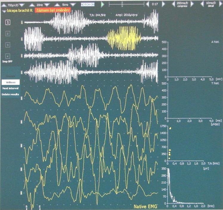 Obrázek 24 Maximální volní kontrakce pro m. biceps brachii 6.1.3 Izometrické zatížení obou končetin současně Pacient má opět umístěné snímací elektrody na m.