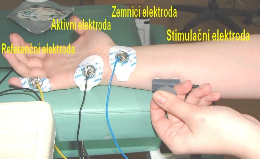 8 cm Obrázek 27 Umístění elektrod při stimulaci n. ulnaris c) Nastavení stimulačního impulzu - je nutné vhodně zvolit délku stimulačního impulzu a také jeho intenzitu.