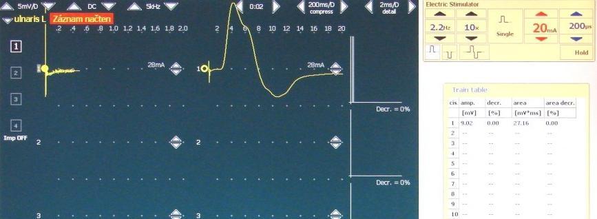To poznáme tak, že se hodnota amplitudy signálu neměnní. Hodnotu této intenzity zvýšíme o 20 % a dostaneme supramaximální stimulus. Dále se nastaví hodnota frekvence repetitivní stimulace.