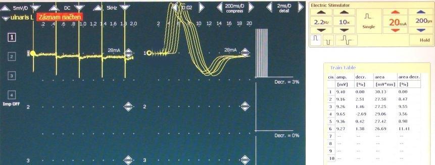 Hodnotí se vyšší vrchol. Jestliže tedy dosáhnete takovéto odpovědi, není to chyba. Případná chyba by mohla nastat, při obrácení polarity snímacích elektrod.