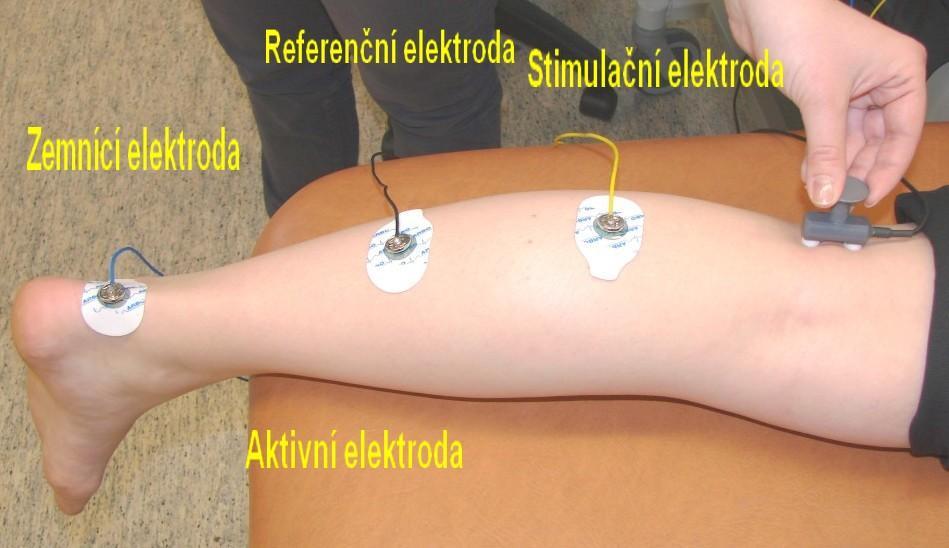 Obrázek 30 Umístění elektrod na DK b) Poté si na stimulátoru nastavíme nízkou hodnotu intenzity stimulu.