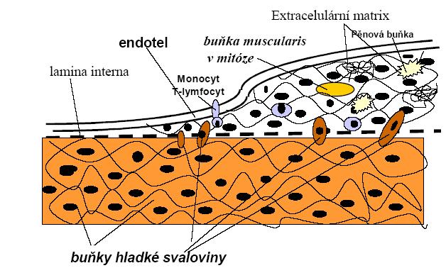 Obrázek 2. Schéma ztlušťování artérie v průběhu aterogeneze (převzato z internetových stránek: http://www.zdravcentra.sk/index.php?
