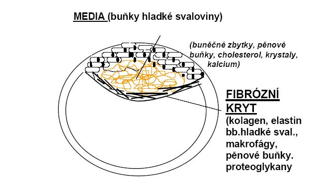 sníţení průtoku cirkulující krve. Na zhrubělém povrchu léze (ateromového plátu) adherují trombocyty.
