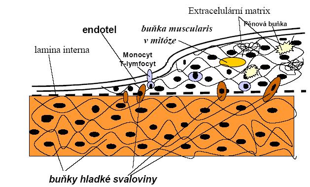 Obrázek 2. Schéma ztlušťování artérie v průběhu aterogeneze (převzato z internetových stránek: http://www.zdravcentra.sk/index.php?