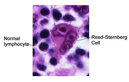 lymfoidní výchozí buňkou je granulocyt - myeloidní