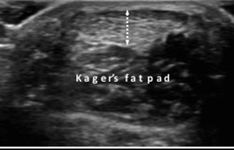 Obr. 21. Axiální sonogram Achillovy šlachy. Přerušovaná linie - předozadní rozměr Achillovy šlachy. Obr. 22. Longitudinální sonogram plantární fascie.