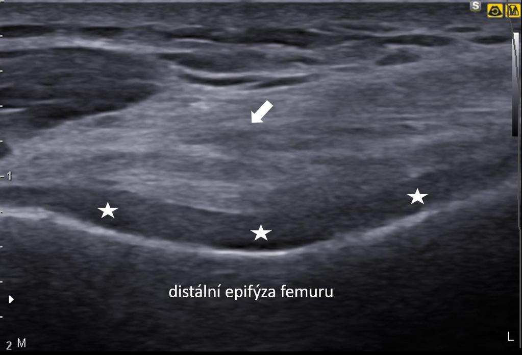 Za horní mez normy tloušťky plantární fascie je typicky považována referenční hodnota 4 mm. Gadalla však následně upozorňuje na vyšší hodnoty i u asymptomatických jedinců (Gadalla N. et al., 2014).