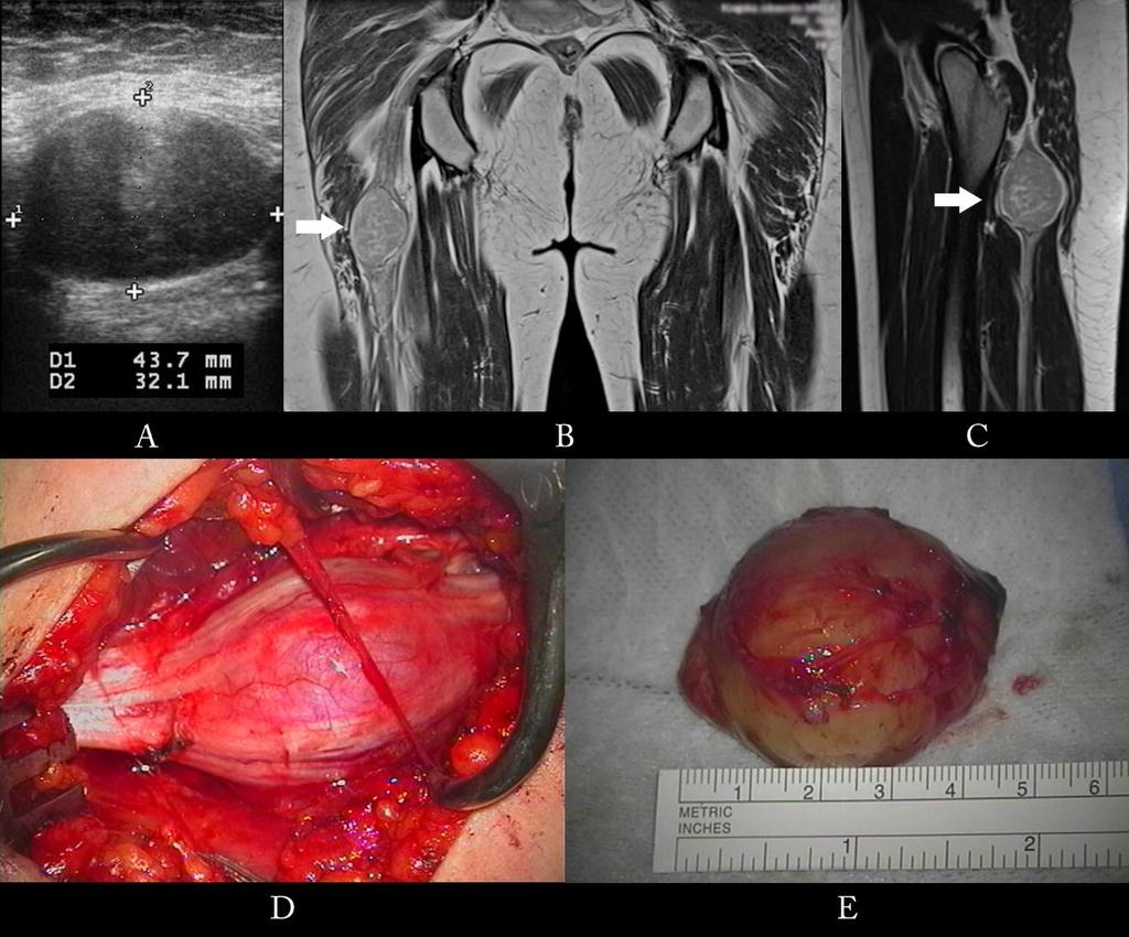 schwannomu postihujícího n. ischiadicus popisují i další kazuistiky (Godkin O. et al., 2016; As Sultany M. et al., 2017). Obr. 38. A axiální sonogram schwannomu n.