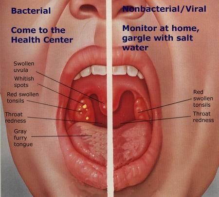 Tonsilitis ( angína ) http://www.medicalook.