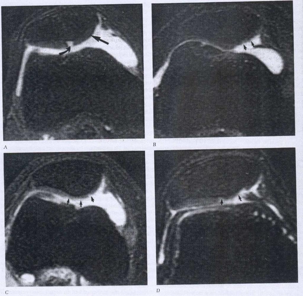 Obr. č. 14 MRI zobrazeni jednotlivých stupňů chondromalacie pately (Deutsch, 1993): A I.stupeň, B II. stupeň, C II. stupeň a D IV.