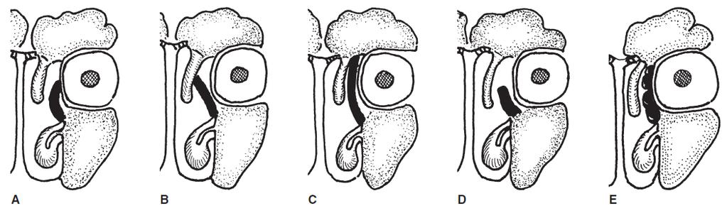 Variace uncinátního výběžku (černě) A: úpon na lamina orbitalis (papyracea), B: úpon na střední skořepu, C: úpon na strop etmoidů, D: končí volně v nosní dutině, E: pneumatizován Variace kraniálního