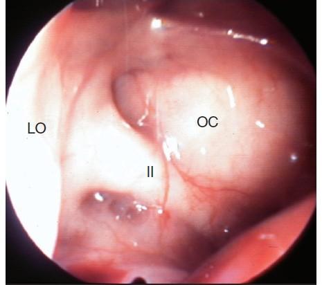 + A levá klínová dutina B B pravá klínová dutina Endoskopický pohled