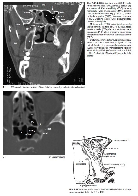 Anatomické struktury okolí klínové dutiny Fissura orbitalis superior (SOF), Onodiho sklep (OC), pneumatizace dorsum sellae (DS). Do lumina klínové dutiny (S) prominuje kanálek n. II (II) a ACI.