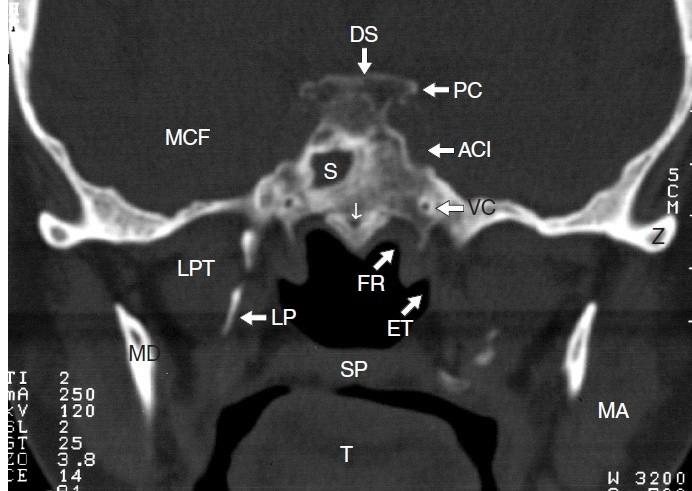 Lební báze v úrovni tureckého sedla II CT, koronární rovina Fossa cranii media (MCF), dorsum sellae (DS), processus clinoideus posterior (PC), ACI, sinus sphenoidalis (S), canalis pterygoideus Vidii