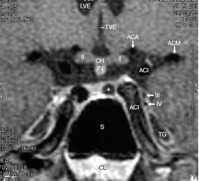 Lební báze v úrovni tureckého sedla III Postranní (LVE) a III. mozková komora (TVE), a. cerebri anterior (ACA), a. cerebri media (ACM), chiasma opticum (CH), n.