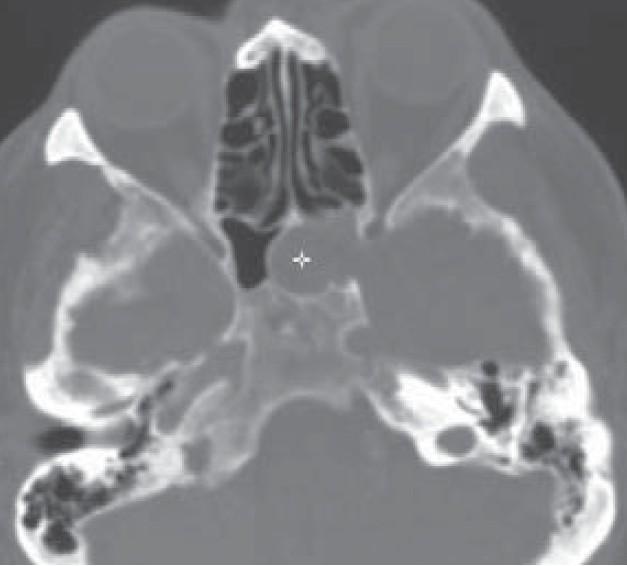 Kazuistika 68letého nemocného s meningoencefalokélou klínové dutiny (+ na obr.