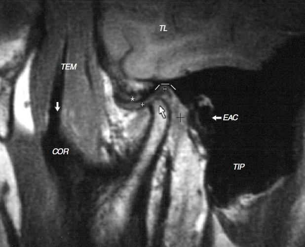 A Temporální lalok T1 W MR * + + B T2 W MR mastoideální hrot vertikální rameno mandibuly C CT Temporomandibulární