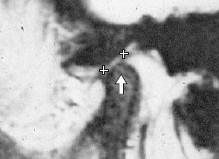 Fossa mandibularis (bílé úsečky), discus articularis (bílý +), condylus mandibulae (šipka nahoru), tuberculum