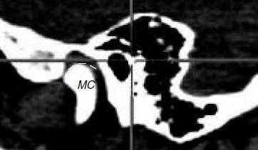 temporalis (TEM) s úponovou šlachou (šipka dolů), processus coronoideus mandibulae (COR). Obr.