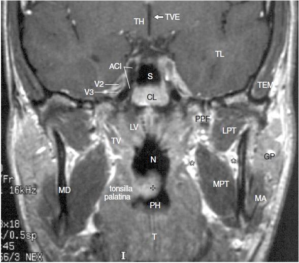 Lební baze v úrovni klínové dutiny a příušní žlázy II III. (TVE) mozková komora, thalamus (TH), temporální lalok (TL), klínová dutina (S), clivus (CL), vertikální úsek ACI, n. maxillaris (V2), n.