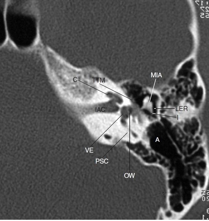 Středoušní dutina s bohatou pneumatizací spánkové kosti Antrum mastoideum (A), incudomaleární skloubení (MIA), krátký výběžek kovadlinky (I), laterální epitympanální reces