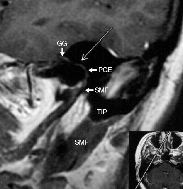 VII (GG) přechází v horizontální tympanální úsek a dále v zadní kolénko (PGE). Kochlea (C), zadní semicirkulární kanálek (PSC) Obr. B: průběh n. VII skalní kostí.
