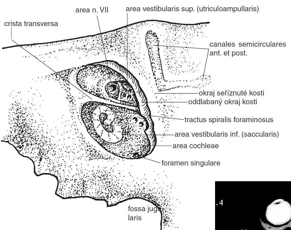 Pohled zezadu do meatus acusticus internus po oddlabání