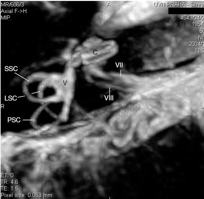 3D MR vnitřního ucha Kochlea (C), vestibulum (V), horní (SSC),