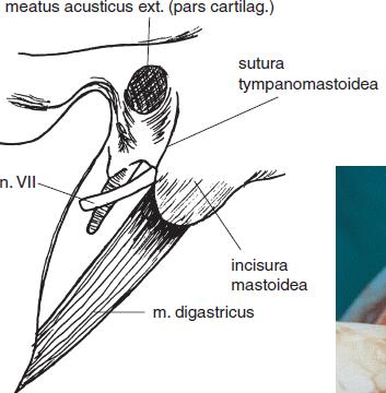 Myxochondroepiteliom hlubokého laloku levé příušní žlázy Prsty odtlačuji tumor od větví lícního nervu, které byly