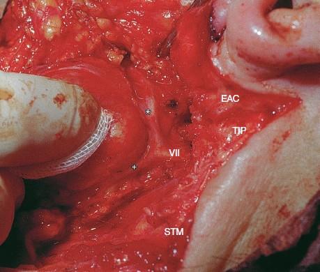 VII (VII), truncus temporofacialis (*), truncus cervicofacialis (+), chrupavčitá část zevního zvukovodu (EAC),