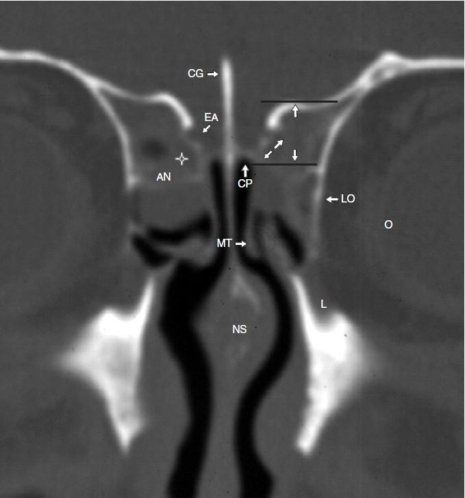 Přední rinobaze Etmoidy, na tomto snímku sklípky agger nasi (AN), zasahují (svislé šipky mezi úsečkami) nad úroveň lamina cribrosa (CP).