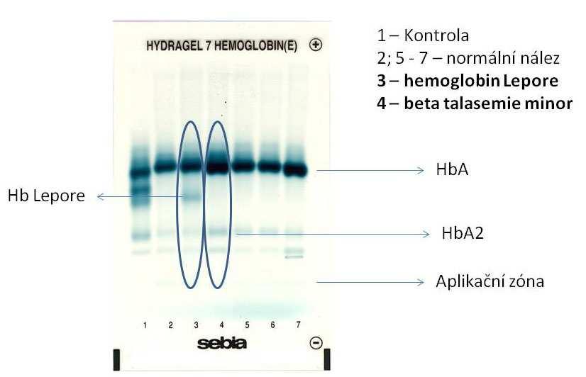 Obrázek 5: ELFO Hb pacient s Hb Lepore (pozice 3) a s beta