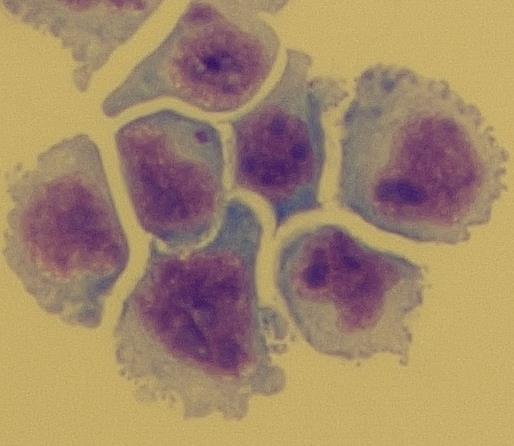 Cytologické vyšetření mozkomíšního moku a pátrání po nádorových buňkách je významné zejména u pacientů s metastatickými tumory, u leukémií, lymfomů,