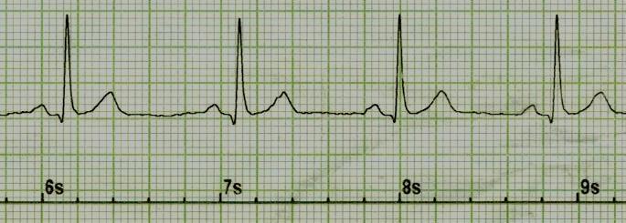 3 Elektrokardiogram Elektrokardiogram je časový záznam srdeční činnosti, která je snímána v podobě bioelektrického signálu.