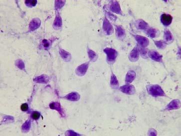 Doba inkubace Obvykle 3 25 dní i déle, nejčastěji mezi 7 10 dny. Příznaky a patologicko anatomický nález Postižené je tenké střevo a to zejména horní část. Průběh onemocnění je často asymptomatický.