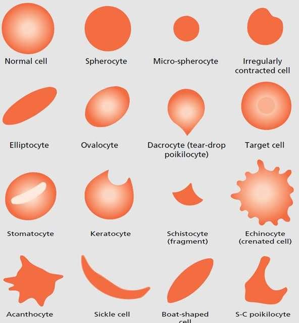 ERYTROCYTY Odchylky od běžného bikonkávního tvaru poikilocytóza - akantocyty (nepravidelné