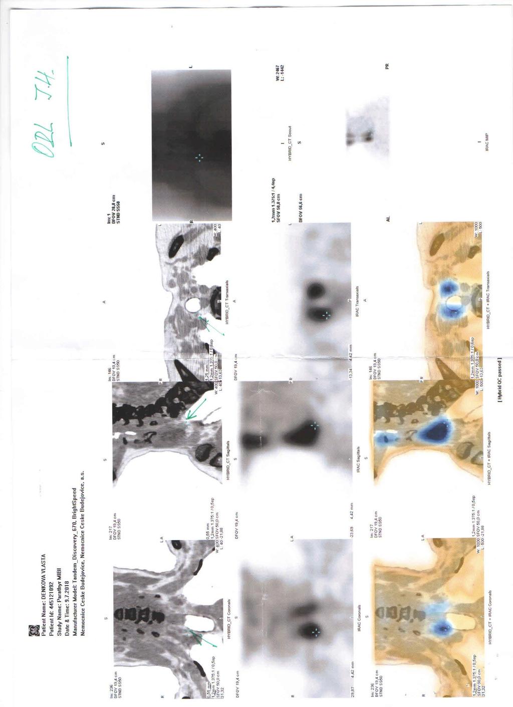 Obr. 2: 99M Tc MIBI + tomografická scintigrafie SPECT doplněná