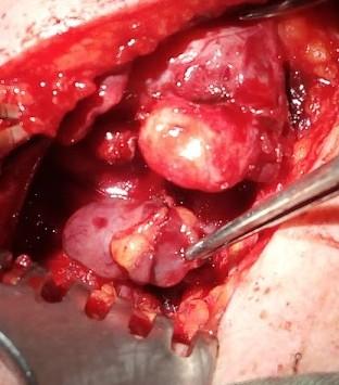 Primární hyperparatyreóza na podkladě adenomu dolního příštítného tělíska vpravo (velikost 2 x 1 x 1 cm) Nodózní struma s papilárním karcinomem Trachea Operace: exstirpace adenomu