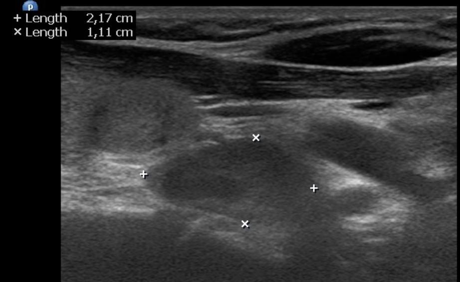 Sonografická diferenciální diagnóza adenomu příštítného tělíska Štítná žláza (zejména její lalůčky a nodozity), lymfatické uzliny, thymus, cysty příštítných tělísek, hygromy Nervově-cévní svazek