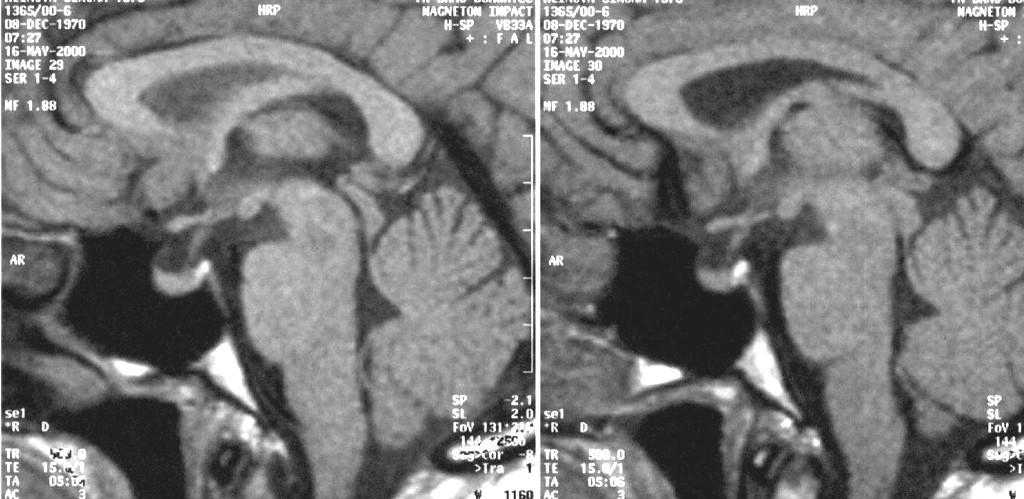 Corpus callosum