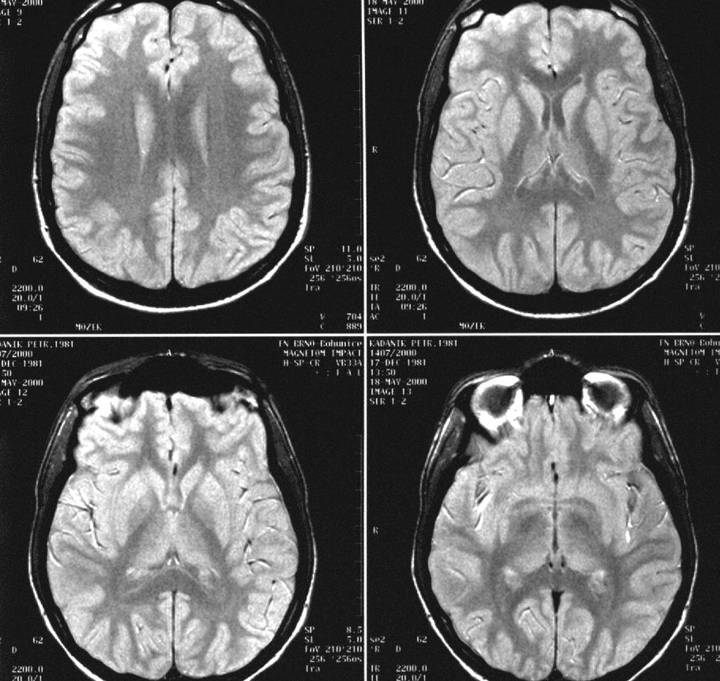 Bazální ganglia MR (protonová denzita)