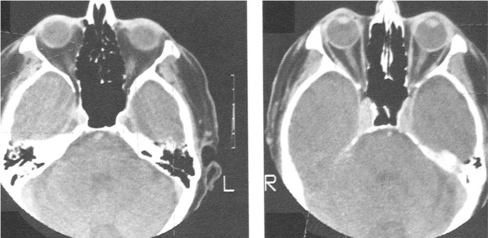 Anatomie orbity - CT -